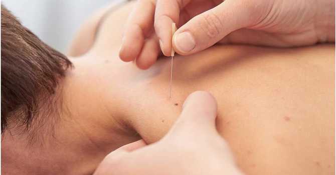 What is Dry Needling? image