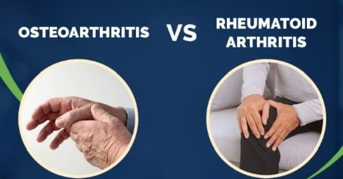 Osteoarthritis & Rheumatoid Arthritis