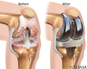 Before - After Knee Replacement