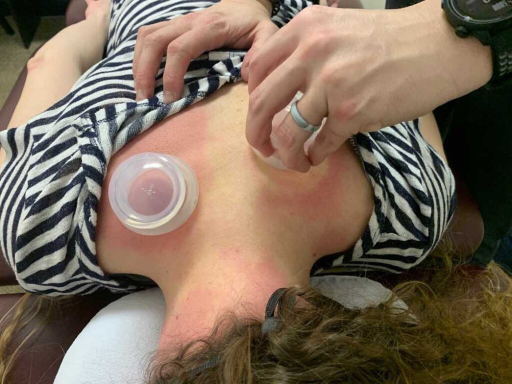 Cupping